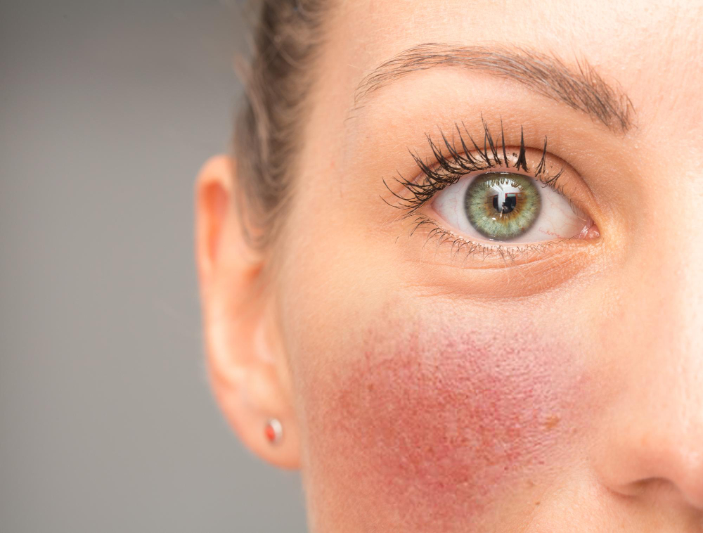 Rosacea